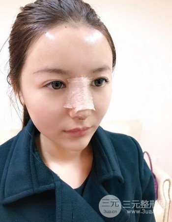 广州隆鼻整形+全脸自体脂肪填充真人案例果分享