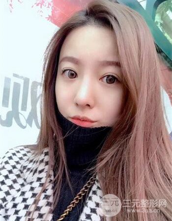 广州隆鼻整形+全脸自体脂肪填充真人案例果分享