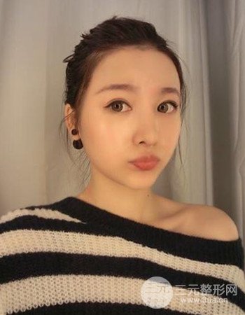 广州隆鼻整形+全脸自体脂肪填充真人案例果分享