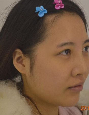 北京吸脂瘦脸真人案例恢复过程分享，巴掌小脸不是梦