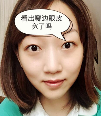 北京双眼皮失败修复手术日记分享，附上前后对比照片