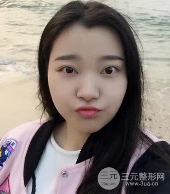 上海王艳隆鼻整形手术记录分享，果对比图分享