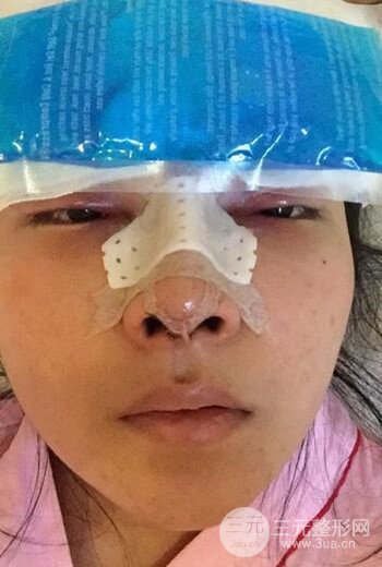 上海王艳隆鼻整形手术记录分享，果对比图分享