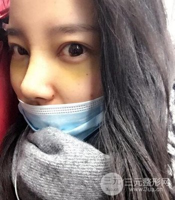 上海王艳隆鼻整形手术记录分享，果对比图分享