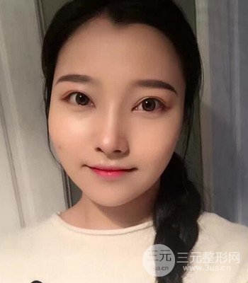 上海王艳隆鼻整形手术记录分享，果对比图分享