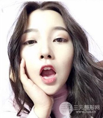 上海王艳隆鼻整形手术记录分享，果对比图分享