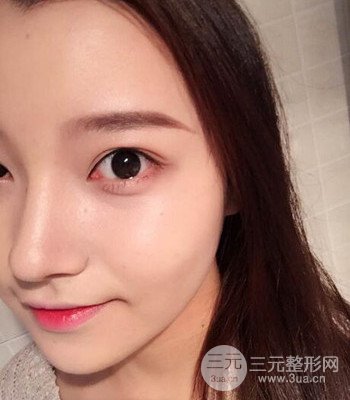 上海王艳隆鼻整形手术记录分享，果对比图分享