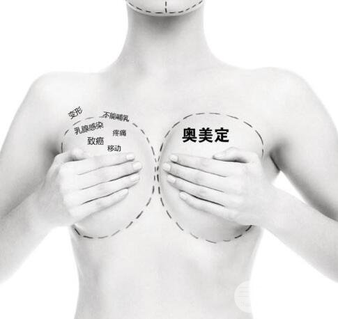 取出乳房奥美定价格贵不贵