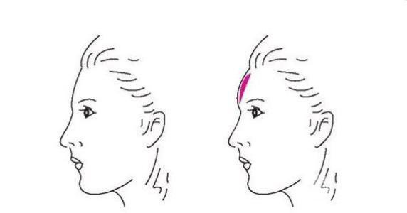 隆额头手术大概需要多少钱？