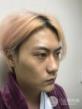 上海翡立思徐晓斐隆鼻整形果分享，帅气十足