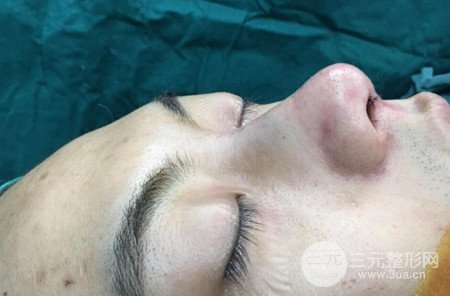 上海翡立思徐晓斐隆鼻整形果分享，帅气十足