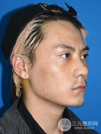 上海翡立思徐晓斐隆鼻整形果分享，帅气十足