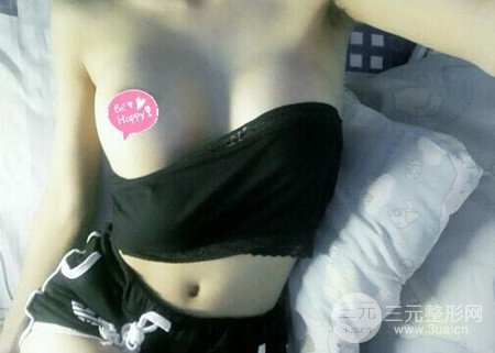 深圳假体隆胸让平胸妹华丽变身，手术果分享