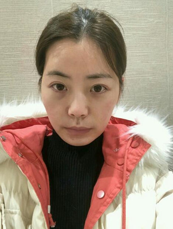 主播在深圳美臣做了自体脂肪全脸填充手术日记分享