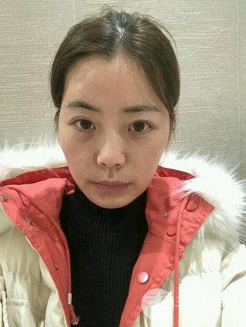 主播在深圳美臣做了自体脂肪全脸填充手术日记分享