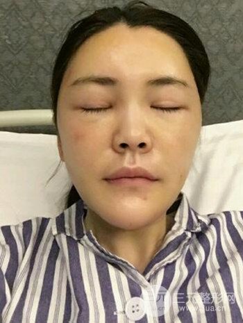 主播在深圳美臣做了自体脂肪全脸填充手术日记分享