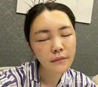 主播在深圳美臣做了自体脂肪全脸填充手术日记分享