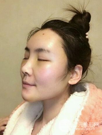 主播在深圳美臣做了自体脂肪全脸填充手术日记分享