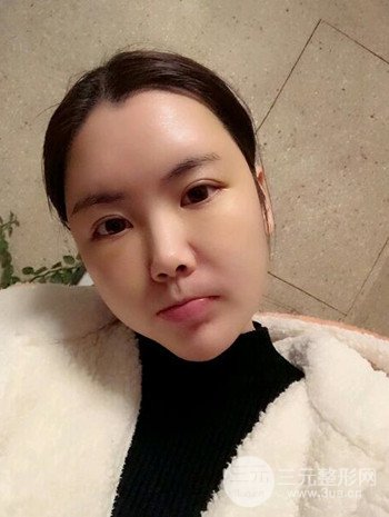 主播在深圳美臣做了自体脂肪全脸填充手术日记分享
