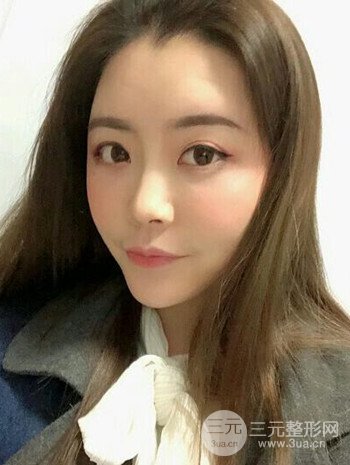 主播在深圳美臣做了自体脂肪全脸填充手术日记分享