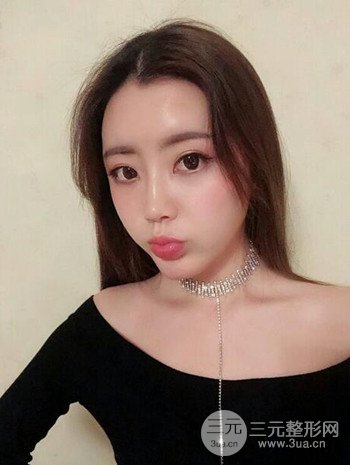 主播在深圳美臣做了自体脂肪全脸填充手术日记分享