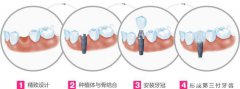 种植牙的过程 手术过程一览
