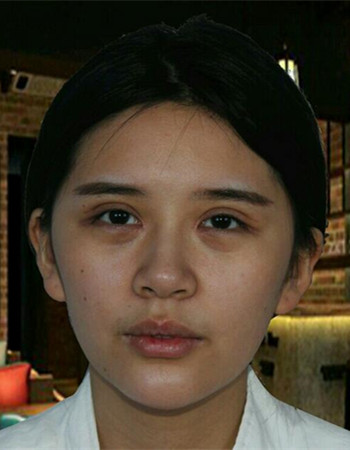 自体脂肪面部填充+内切祛眼袋术后果分享，阿姨立变小仙女