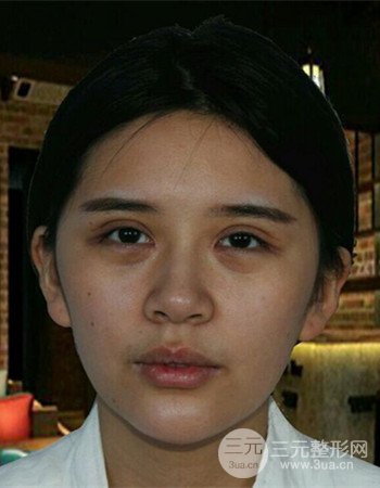 自体脂肪面部填充+内切祛眼袋术后果分享，阿姨立变小仙女