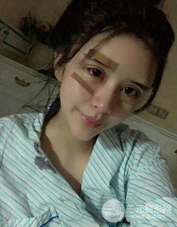 自体脂肪面部填充+内切祛眼袋术后果分享，阿姨立变小仙女