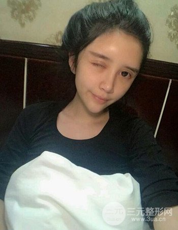 自体脂肪面部填充+内切祛眼袋术后果分享，阿姨立变小仙女