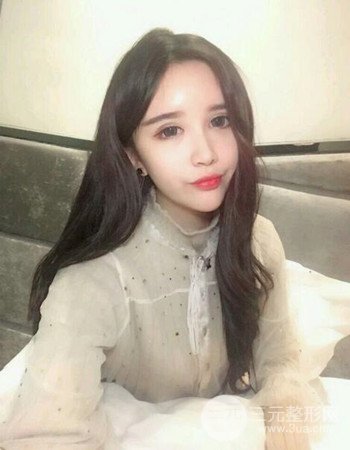 自体脂肪面部填充+内切祛眼袋术后果分享，阿姨立变小仙女