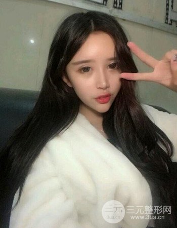 自体脂肪面部填充+内切祛眼袋术后果分享，阿姨立变小仙女