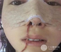 隆鼻整形当场样子和恢复 隆鼻整形术后多久恢复 隆鼻整形当场样子和恢复 隆鼻整形术后多久恢复