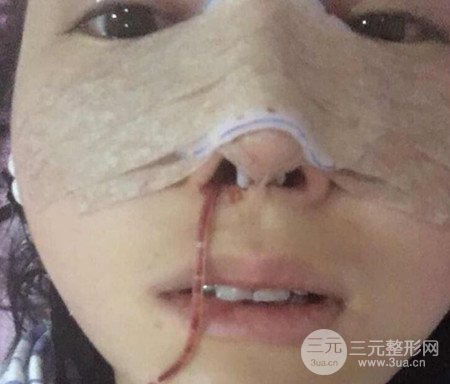 隆鼻整形当场样子和恢复 隆鼻整形术后多久恢复