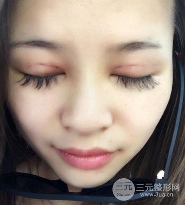上海双眼皮手术真人案例恢复过程分享