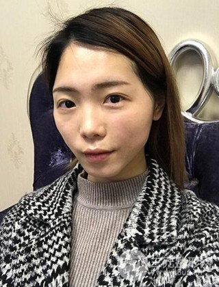 在上海诺诗做了自体脂肪填充全脸真人案例大曝光