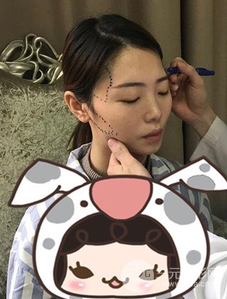 在上海诺诗做了自体脂肪填充全脸真人案例大曝光