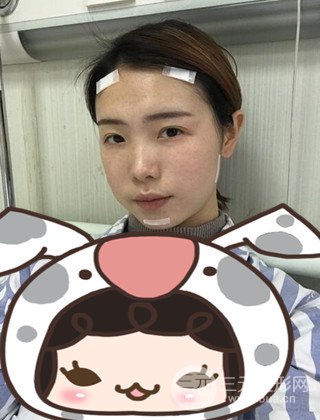 在上海诺诗做了自体脂肪填充全脸真人案例大曝光