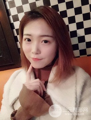 在上海诺诗做了自体脂肪填充全脸真人案例大曝光