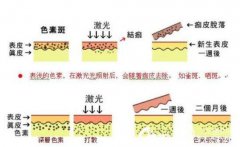 光子嫩肤价格是多少