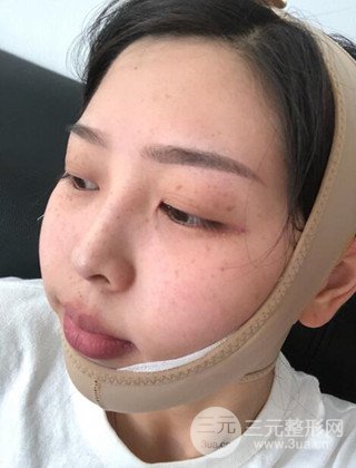 面部吸脂瘦脸手术日记分享，瘦脸果惊人