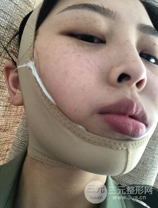 面部吸脂瘦脸手术日记分享，瘦脸果惊人