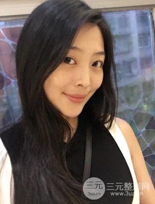 面部吸脂瘦脸手术日记分享，瘦脸果惊人