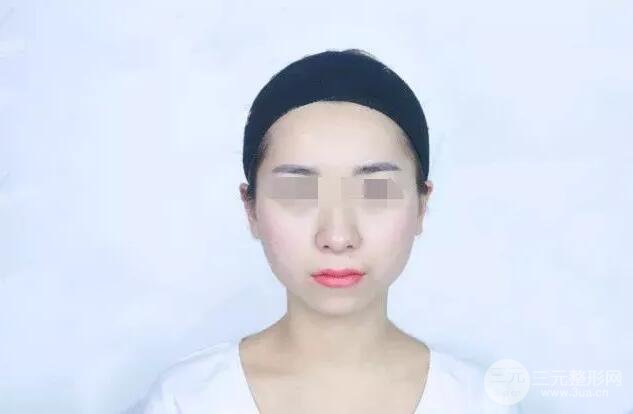 瑞兰隆鼻多少钱 瑞兰隆鼻真实一个月恢复前后对比图案例