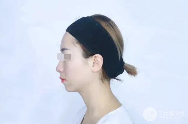 瑞兰隆鼻多少钱 瑞兰隆鼻真实一个月恢复前后对比图案例
