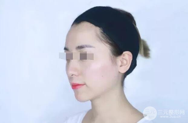 瑞兰隆鼻多少钱 瑞兰隆鼻真实一个月恢复前后对比图案例