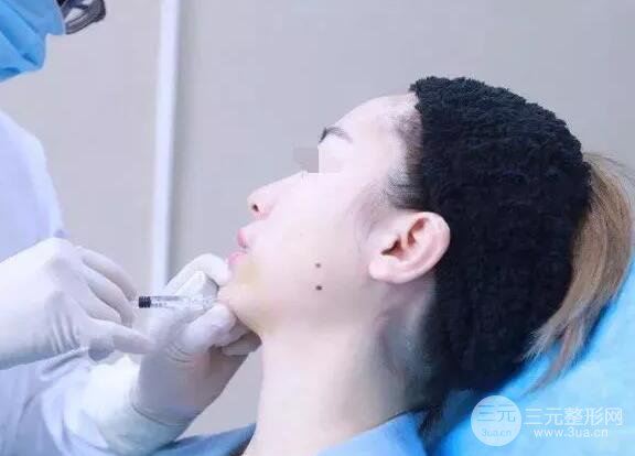 瑞兰隆鼻多少钱 瑞兰隆鼻真实一个月恢复前后对比图案例
