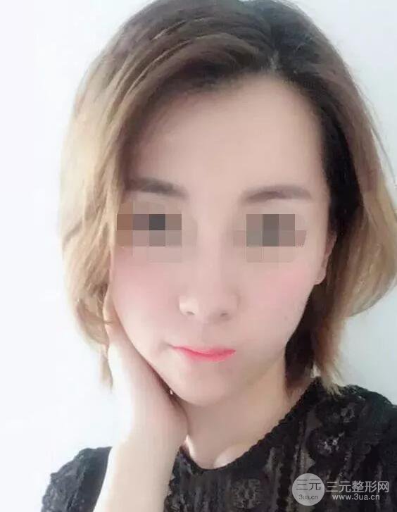 瑞兰隆鼻多少钱 瑞兰隆鼻真实一个月恢复前后对比图案例