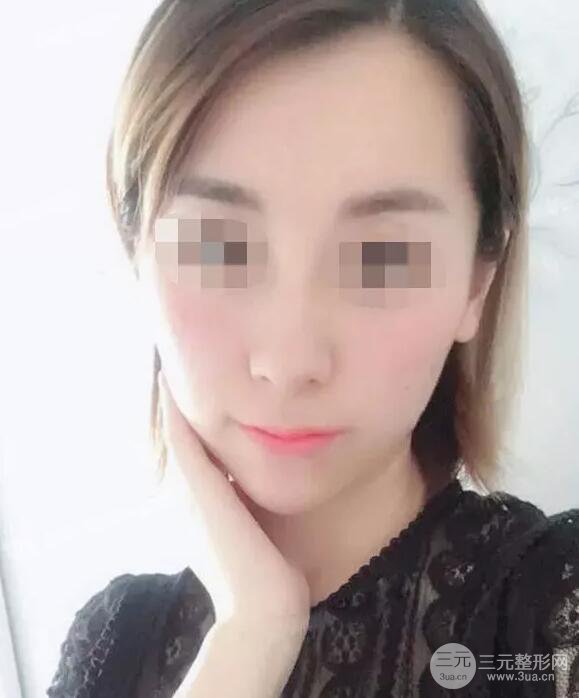 瑞兰隆鼻多少钱 瑞兰隆鼻真实一个月恢复前后对比图案例