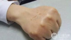 手上老年斑怎么有去掉 价格一般是多少？